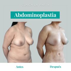 Abdominoplastia - Dr. Pedro Vidal G-H