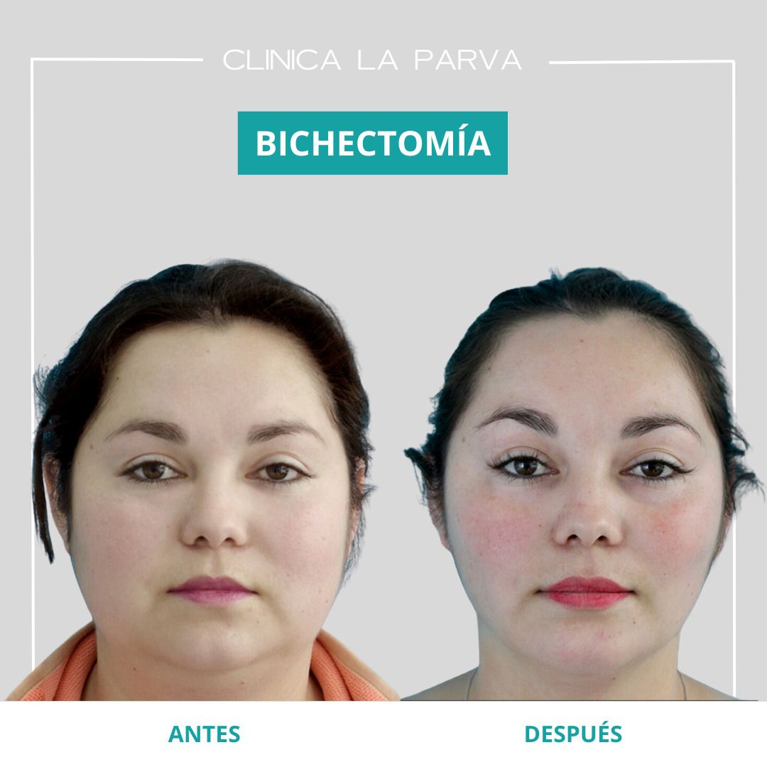 Lifting Facial - Clínica La Parva - Santiago, Chile