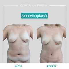 Abdominoplastia - Dr. Pedro Vidal G-H