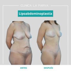 Lipoabdominoplastía - Dr. Pedro Vidal G-H