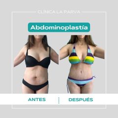 Abdominoplastia - Dr. Pedro Vidal G-H