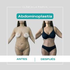Abdominoplastia - Dr. Pedro Vidal G-H