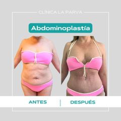 Abdominoplastia - Dr. Pedro Vidal G-H