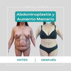 Abdominoplastia - Dr. Pedro Vidal G-H
