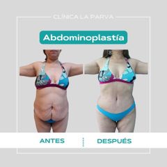 Abdominoplastia - Dr. Pedro Vidal G-H