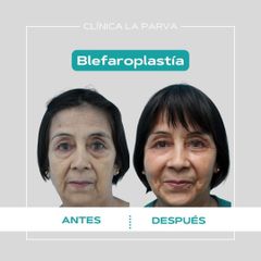 Blefaroplastía - Dr. Pedro Vidal G-H