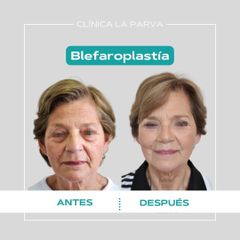 Blefaroplastía - Dr. Pedro Vidal G-H
