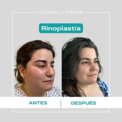 Rinoplastia - Dr. Pedro Vidal G-H