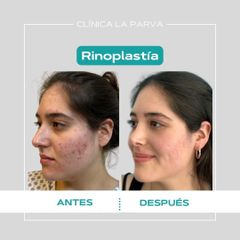 Rinoplastia - Dr. Pedro Vidal G-H