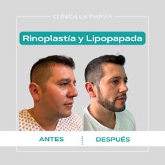 Rinoplastia - Dr. Pedro Vidal G-H
