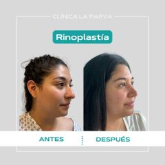 Rinoplastia - Dr. Pedro Vidal G-H