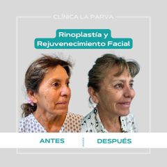 Rinoplastia - Dr. Pedro Vidal G-H