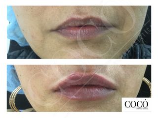 Aumento de labios - Cocó Medicina Estética