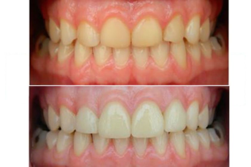 Limpieza dental antes y después - 497838