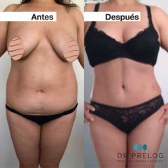 Abdominoplastia - Dr. Max Prelog