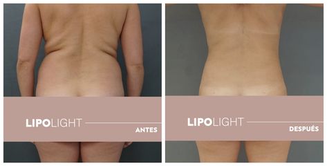 Liposucción - Dr. Max Prelog