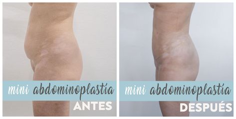 abdominoplastia - Dr. Max Prelog