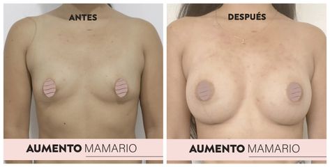 aumento mamario - Dr. Max Prelog