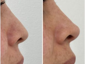 Rejuvenecimiento facial antes y después - 870199