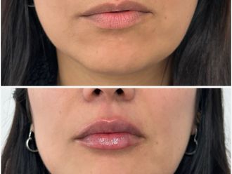 Aumento de labios antes y después - 870237