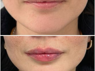 Aumento de labios antes y después - 870239