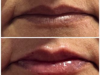 Aumento de labios antes y después - 870242