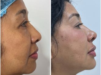 Rejuvenecimiento facial antes y después - 870248