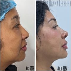 Rejuvenecimiento facial perfiloplastia - Dra. Danna Ferreira