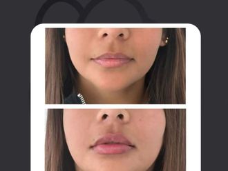 Aumento de labios antes y después - 870255