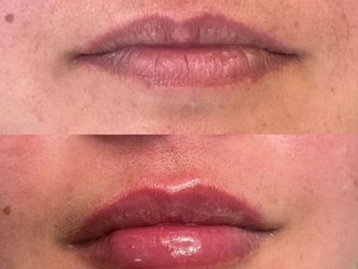 Aumento de labios antes y después - 871776