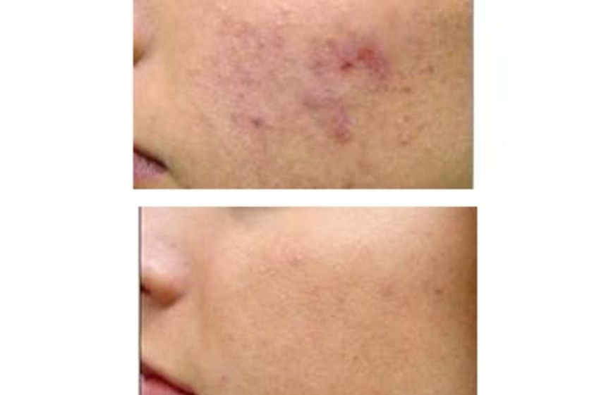 Tratamiento acné antes y después - 487137