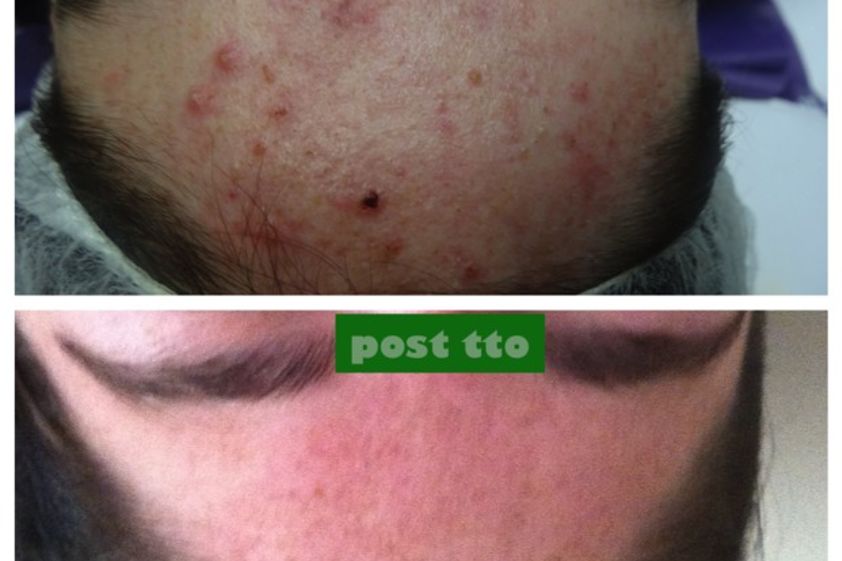 Tratamiento acné antes y después - 484337