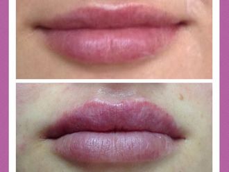 Aumento de labios - 639569