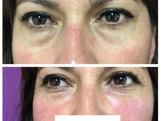 Tratamiento de ojeras - 639571