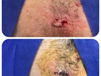 Microdermoabrasión antes y después - 646389