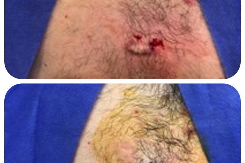 Microdermoabrasión antes y después - 646389
