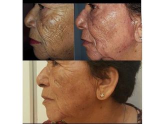 Peeling - 640737