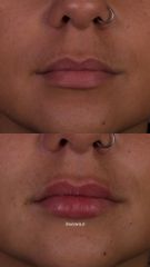 Aumento de labios - Dra. Victoria Pérez
