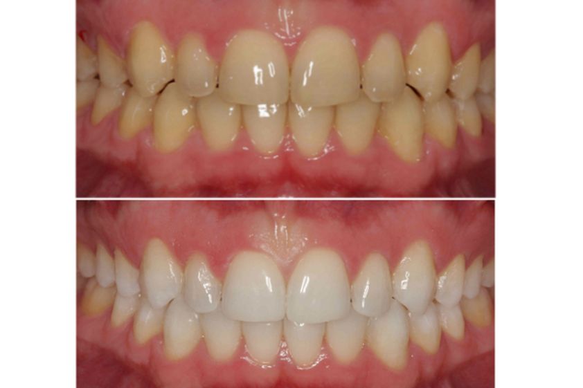 Limpieza dental antes y después - 500115