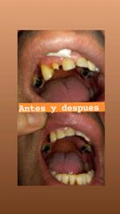 Implantes dentales - Clínica A-Dent SC