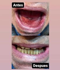 Implantes dentales - Clínica A-Dent SC