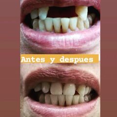 Implantes dentales - Clínica A-Dent SC