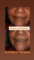 Prótesis dentales - Clínica A-Dent SC