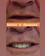 Implantes dentales - Clínica A-Dent SC