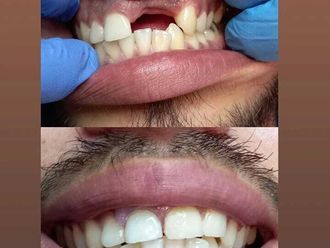 Implantes dentales - 812775