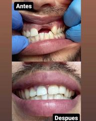 Implantes dentales - Clínica A-Dent SC