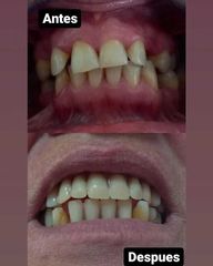 Carillas de porcelana - Clínica A-Dent SC
