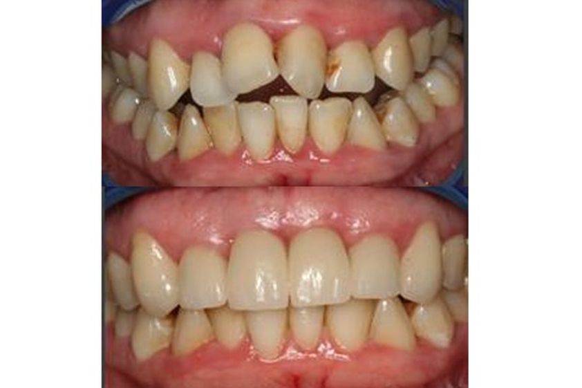 Ortodoncia antes y después - 487031