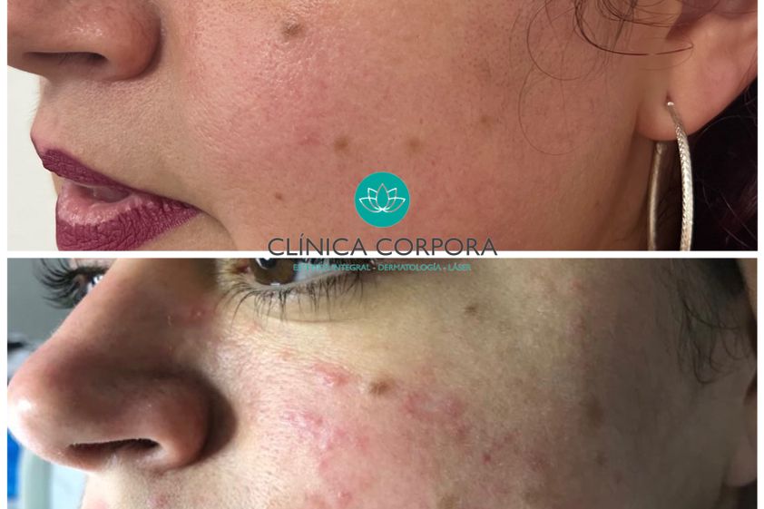 Tratamiento acné antes y después - 848582