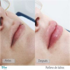 RELLENO LABIOS 